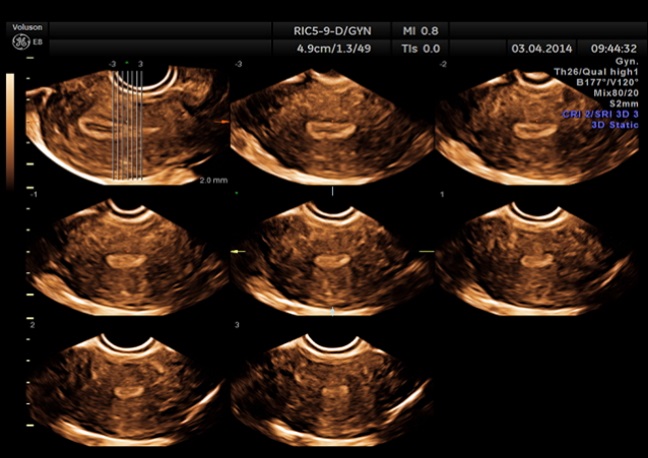 uteronormale in 3D con tecnica TUI