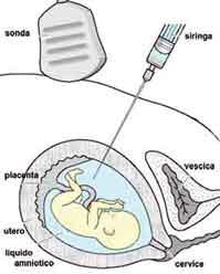schema di esecuzione dell’amniocentesi