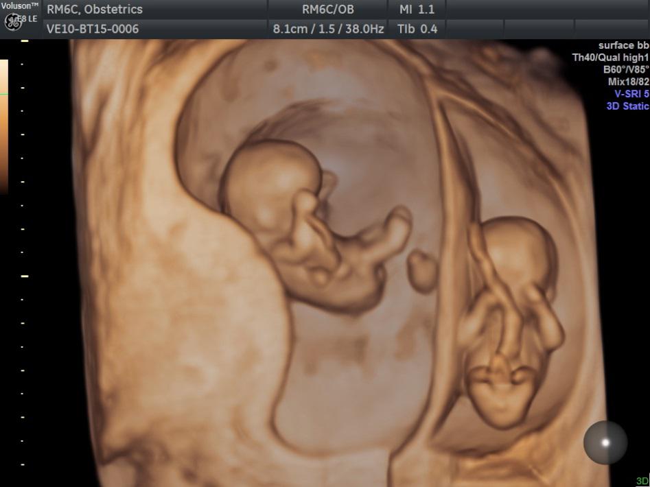 Gravidanza gemellare all’ottava settimana in visione 3D
