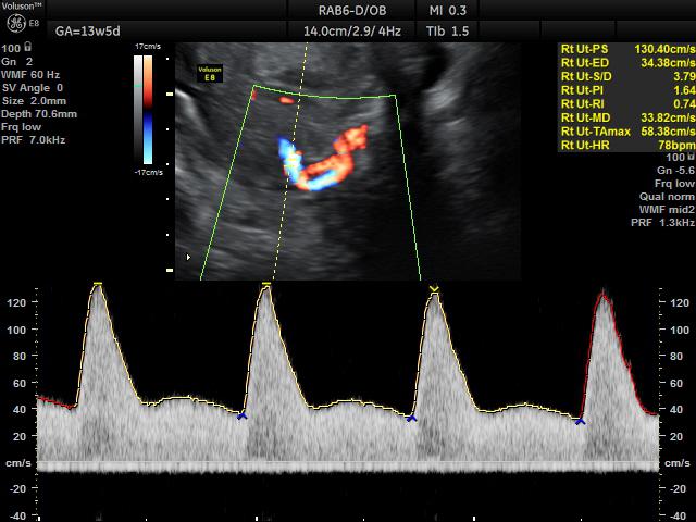 screening preeclampsia - flussimetria dell’arteria uterina a 13 settimane