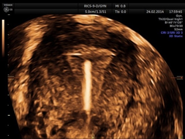 Immagine 3D di spirale in utero
